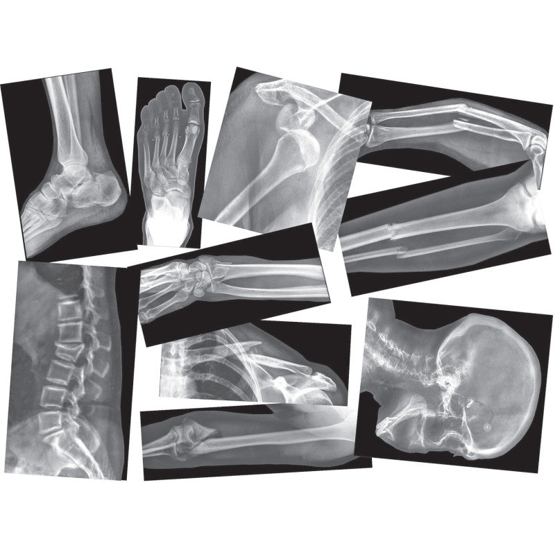 ROYLCO - Broken Bones X-Ray Set, Pack of 15