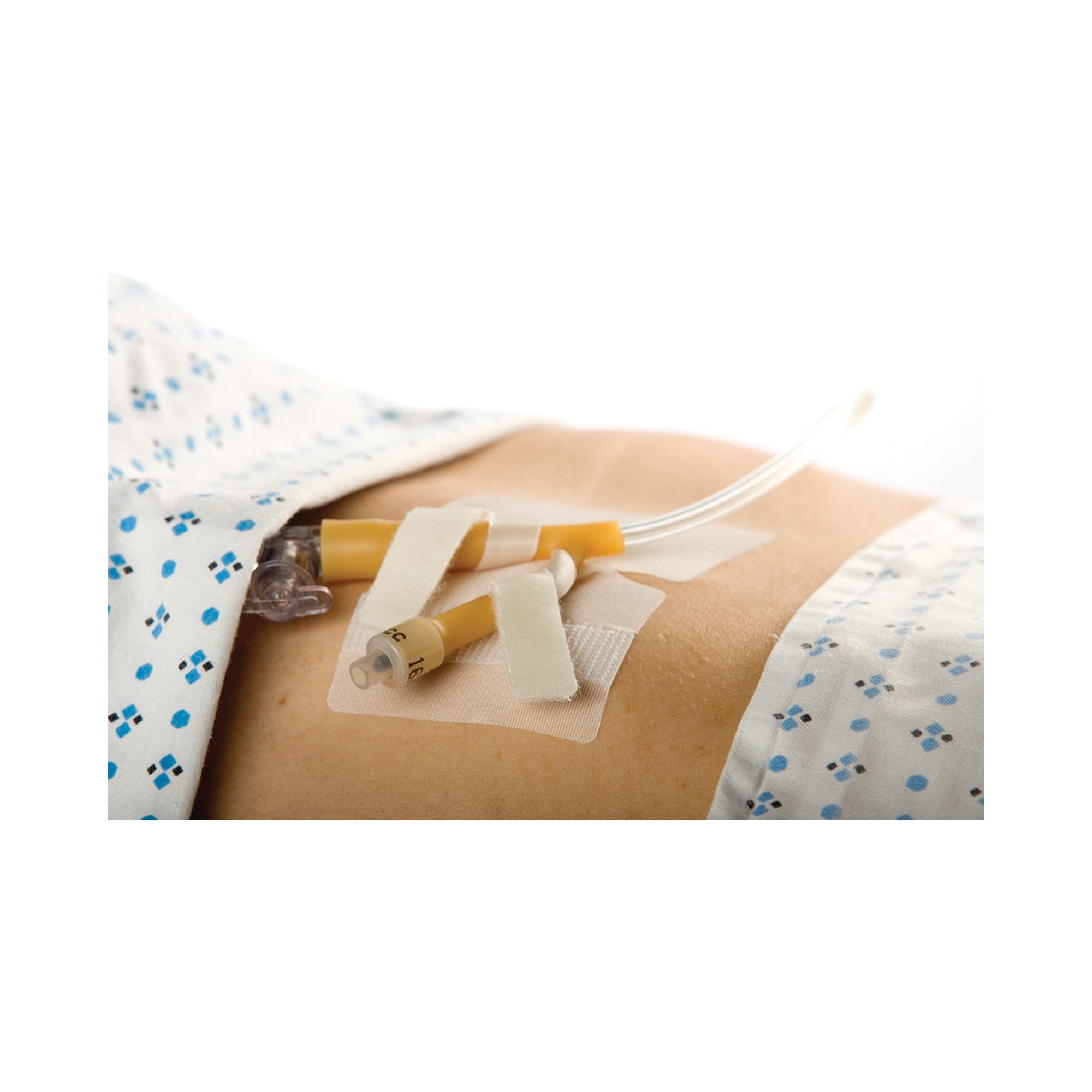 M.C. Johnson - Catheter Holder Cath-Secure Dual Tab® 3 Inch Wrap Tabs x 3 Inch Wide Base [50/BX]